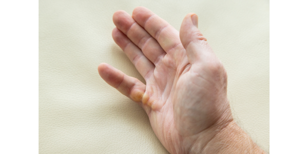 hand-dupuytren