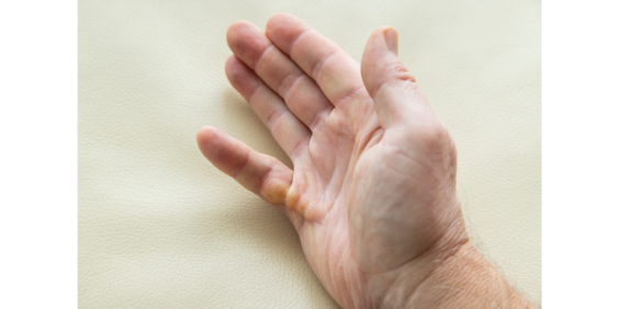 hand-dupuytren